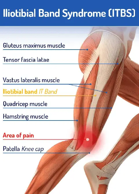 Iliotibial IT Band Syndrome Treatment, Causes and Symptoms